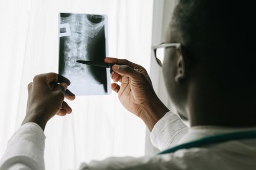 Spinal cord stimulation (SCS)